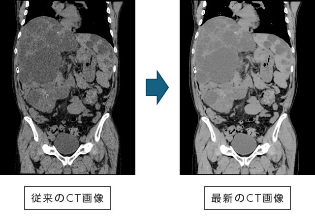 従来のCT画像と最新のCT画像の比較