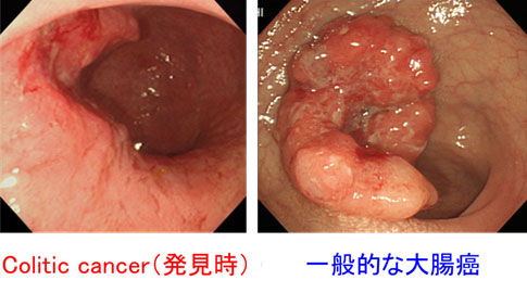 潰瘍性大腸炎のがん化2