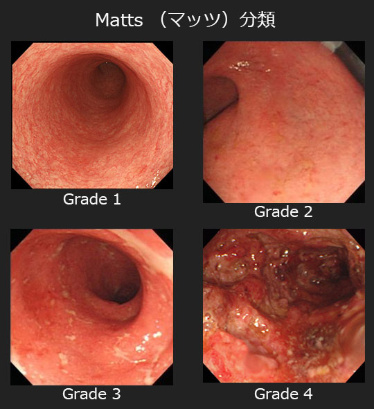 大腸内視鏡検査2
